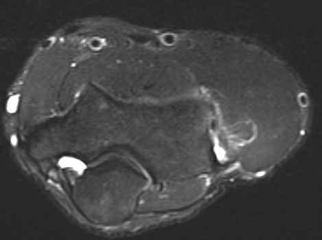 Tennis elbow High grade tear MRI